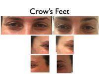 How Many Injections Of Botox For Crow's Feet
