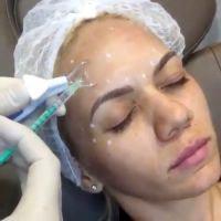 How Many Units Of Botox Will You Need And What Is The Cost