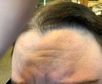 How To Get Rid Of Frown, Glabella Or Furrow Lines On Forehead