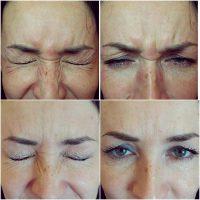 How To Get Rid Of Frown Lines 6 Alternatives To Botox