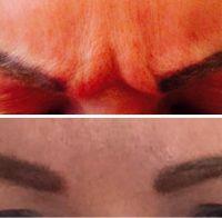How To Get Rid Of Frown Lines Without Botox