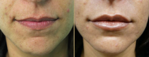 Hydrelle Injection For Treating Laugh Lines Or Nasolabial Folds With Dr Sanusi Umar, MD, Redondo Beach Dermatologic Surgeon