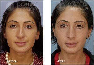 Injectables And Fillers By Kristin A. Boehm, M.D., FACS, Plastic Surgeon In Atlanta, GA (1)