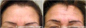 Injecting Botox Into Her Forehead And Between Her Eyes By Dr. Frank Campanile, MD, Denver CO Plastic Surgeon