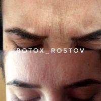 Is Botox Between Eyebrows Safe