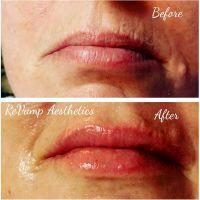 JUVEDERM Injectable Gel Filler Before And After