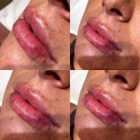 JUVEDERM Ultra XC Is For Injection Into The Lips