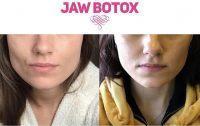 Jaw Botox Pre And Post
