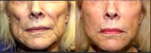 Juvederm And Radiesse At Timeless Plastic Surgery In Houston