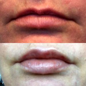 Juvederm At The Waldorf Center For Plastic Surgery