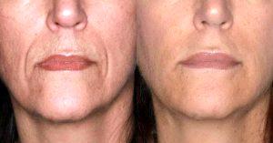 Juvederm At Timeless Skin Solutions, Skin Care Clinic In Dublin, Ohio