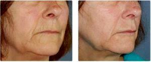 Juvederm, Belotero, Radiesse & 2 Spots Botox By Dr. Dina Eliopoulos, MD, Chelmsford MA Plastic Surgeon (1)