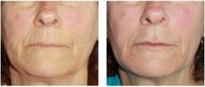 Juvederm, Belotero, Radiesse & 2 Spots Botox By Dr. Dina Eliopoulos, MD, Chelmsford MA Plastic Surgeon (2)