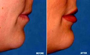 Juvederm Filler To Uppper And Lower Lip With Dr Thomas E. Kaniff, MD, FACS, Sacramento Facial Plastic Surgeon