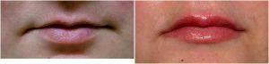 Juvederm For Lips By Donald Keamy, Jr., M.D., MPH, Otolaryngologist In Boston, Massachusetts
