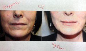Juvederm For Lips By Dr. Lee B. Daniel, Plastic Surgeon In Eugene, Oregon
