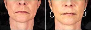 Juvederm In The Peri-Oral Wrinkles & Cheeksby Dr. Goesel Anson, Plastic Surgeons In The Clark County, Nevada