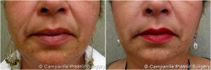 Juvederm Injected Into The Lines By Dr. Frank Campanile, MD, Denver CO Plastic Surgeon