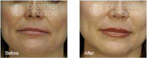 Juvederm Injected To The Lips And Laugh Lines By Kristin A. Boehm, M.D., FACS, Plastic Surgeon In Atlanta, GA