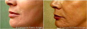 Juvederm Into The Lines Between Her Nose And Mouth By Dr. Frank Campanile, MD, Denver CO Plastic Surgeon