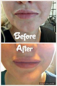 Juvederm Lip Augmentation At Flawless Fillers In Austin