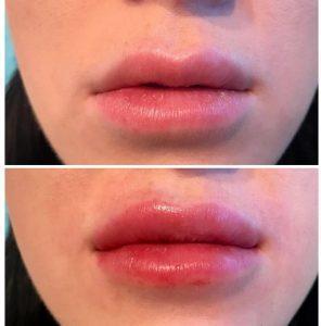 Juvederm Lip Filler By Dr. Lane Smith M.D., Las Vegas Plastic Surgeon