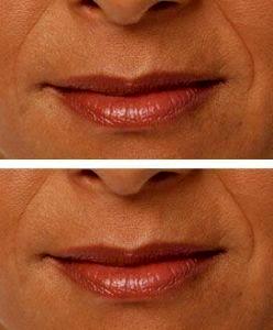 Juvederm Lip Treatment By Dr. Benjamin C. Stong, MD, Atlanta GA Facial Plastic Surgeon