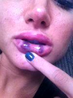 Juvederm Lips Bruising