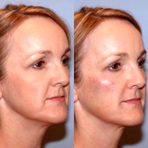 Juvederm To Cheeks By Dr. Elisa A. Burgess, Plastic Surgeon In Lake Oswego, Oregon