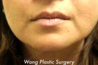 Juvederm To Improve Marionette Lines By Doctor Stewart Wang, MD, FACS, Los Angeles Plastic Surgeon