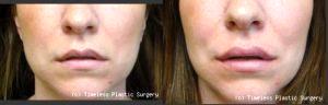 Juvederm To Lips At Timeless Plastic Surgery In Houston
