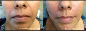 Juvederm To Nasolabial Folds At Timeless Plastic Surgery In Houston