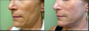 Juvederm To Nasolabial Folds (Smile Lines) At Timeless Plastic Surgery In Houston
