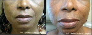 Juvederm To Nasolabial Folds (Smile Lines), Marionette Lines, And Lips At Timeless Plastic Surgery In Houston