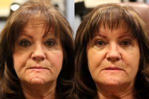 Juvederm To Scar By By Dr. Jeffrey Raval, MD, Denver, CO Plastic Surgeon