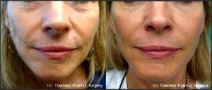 Juvederm To Smile Lines At Timeless Plastic Surgery In Houston