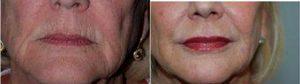 Juvederm Treament For Lips And Marionettes Before & After By Dr Emil A. Tanghetti, MD, Sacramento Dermatologist