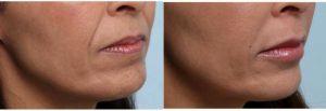 Juvederm Ultra Before And After