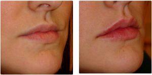 Juvederm Ultra Plus XC By Dr. Dina Eliopoulos, MD, Chelmsford MA Plastic Surgeon