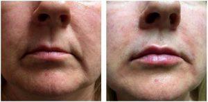 Juvederm Ultra XC And Volbella To Add Volume In The Pink And White Lip, Nasolabial And Marionettes By Scottsdale Plastic Surgeon, Dr. John J. Corey, MD
