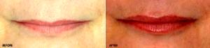 Juvederm - Upper And Lower Lip By Dr Thomas E. Kaniff, MD, FACS, Sacramento Facial Plastic Surgeon