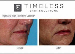 Juvederm Volbella At Timeless Skin Solutions, Skin Care Clinic In Dublin, Ohio