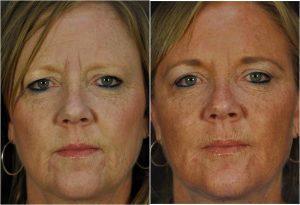 Juvederm, Voluma & Botox By Goesel Anson, MD, FACS, Plastic Surgeon In The Clark County, Nevada (1)