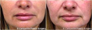Juviderm Into The Deepening Folds Between Her Nose And Mouth By Dr. Frank Campanile, MD, Denver CO Plastic Surgeon