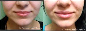 Juviderm Lips At Timeless Plastic Surgery In Houston