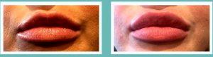 Juviderm Of Lips By Elizabeth McRae MD, Doctor In Boerne, Texas