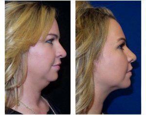Kybella At Skintastic Cosmetic Surgery And Laser Skincare Centers In Dallas