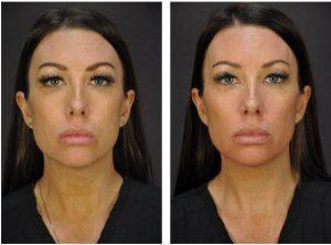 Kybella By Goesel Anson, MD, FACS, Plastic Surgeon In The Clark County, Nevada (1)