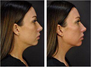 Kybella By Goesel Anson, MD, FACS, Plastic Surgeon In The Clark County, Nevada (2)