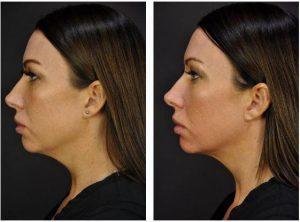 Kybella By Goesel Anson, MD, FACS, Plastic Surgeon In The Clark County, Nevada (3)